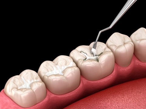 Fillings