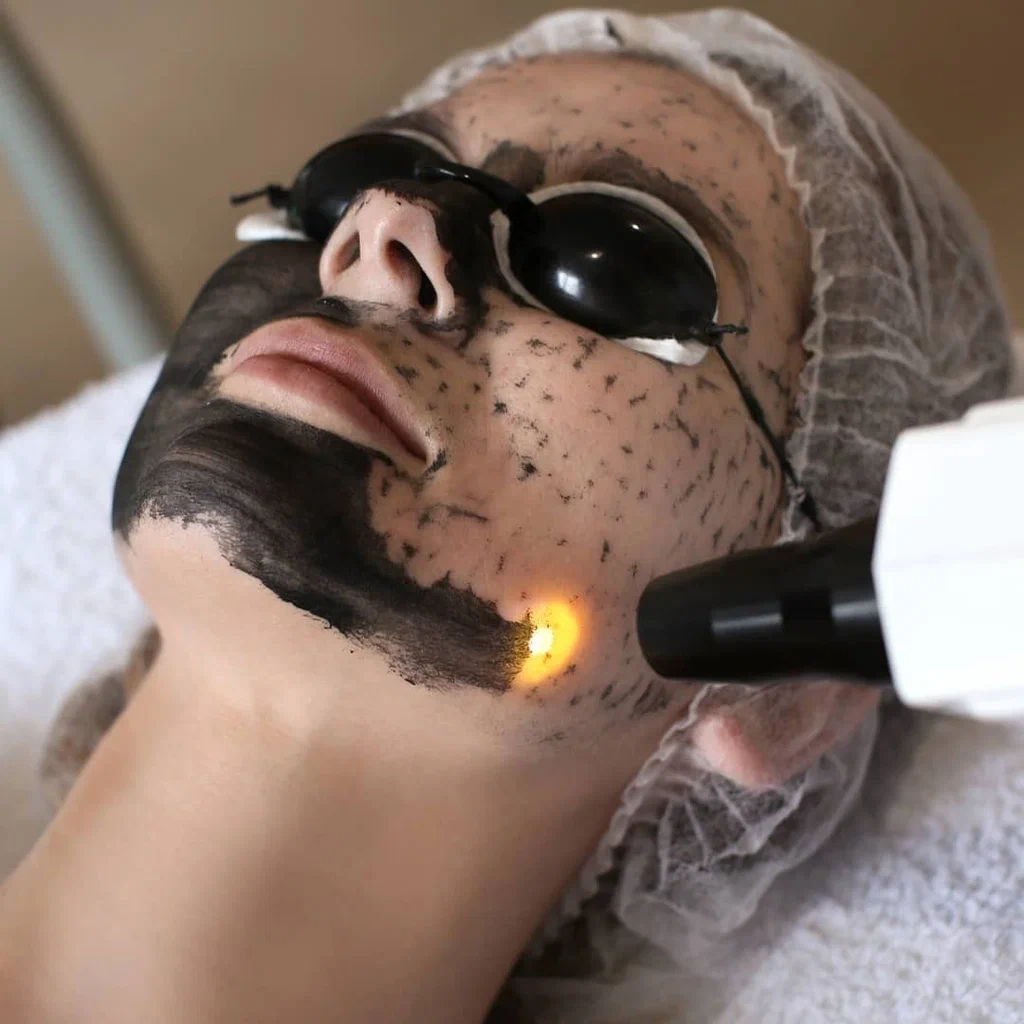 Carbon Facial