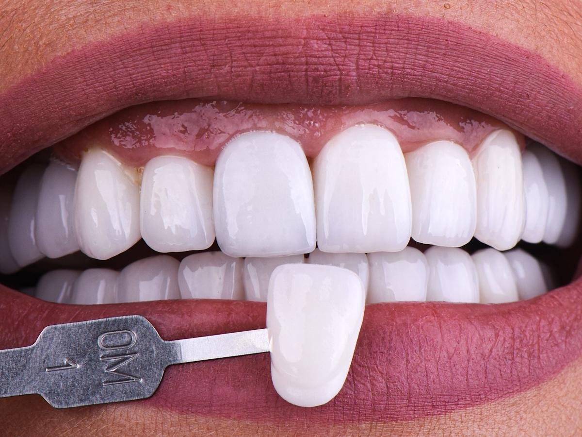 Veneers